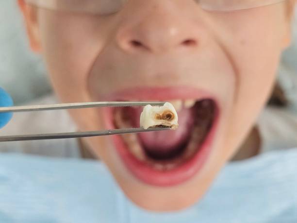 Best Emergency Root Canal Treatment in Wentworth, NC